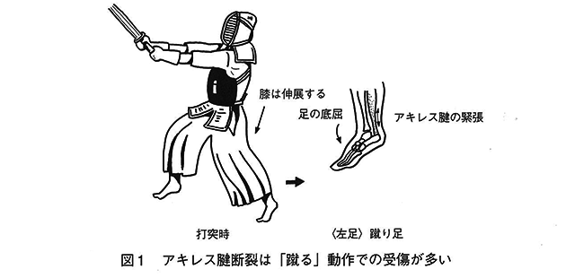 図１アキレス腱断裂は「蹴る」動作での受傷が多い